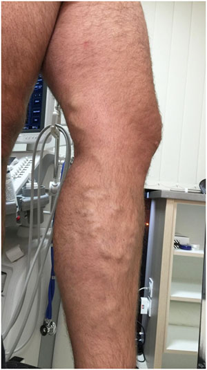 EndoVenous Laser treatment