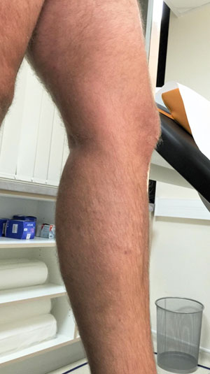 EndoVenous Laser treatment
