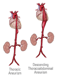 Thoracic Aortic Aneurysm Treatment Gurgaon