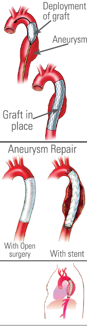 thoracic endovascular aneurysm repair