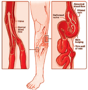 varicose and spider veins