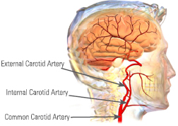 Carotid Artery Disease treated