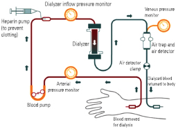 Dialysis