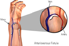 AV Fistula