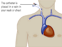 Catheter/Permacath